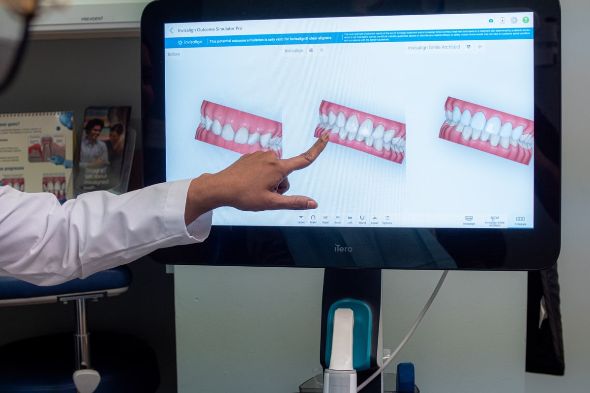 X-rays showing how Invisalign helped straighten a patient's teeth
