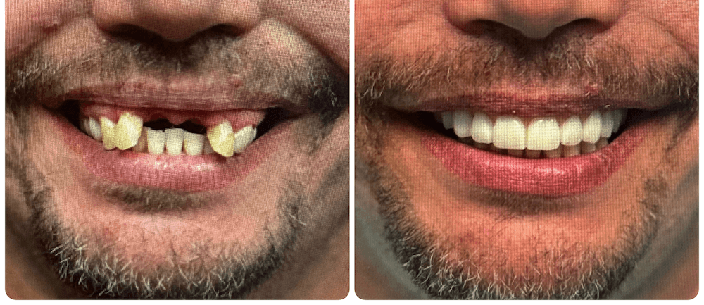 Elite Dental all on six dental implants. 